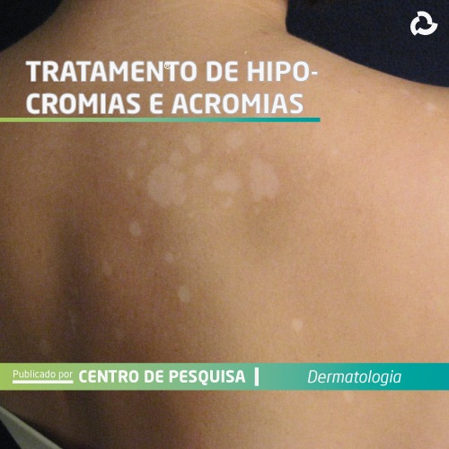 Tratamento de hipocromias e acromias Centro de Pesquisa e Inovação