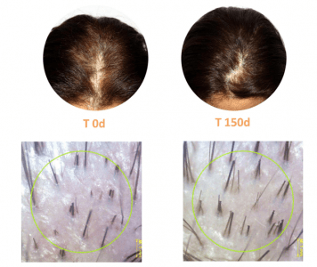 Tratamento estudo IIA Tratamento da queda de cabelo