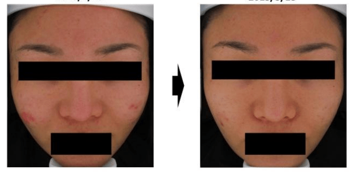 acne e poros 