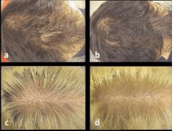 Eficácia no tratamento da alopecia androgênica com S-equol