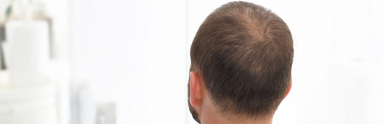 Alopecia.,The,Head,Of,A,Man,With,Thinning,Hair